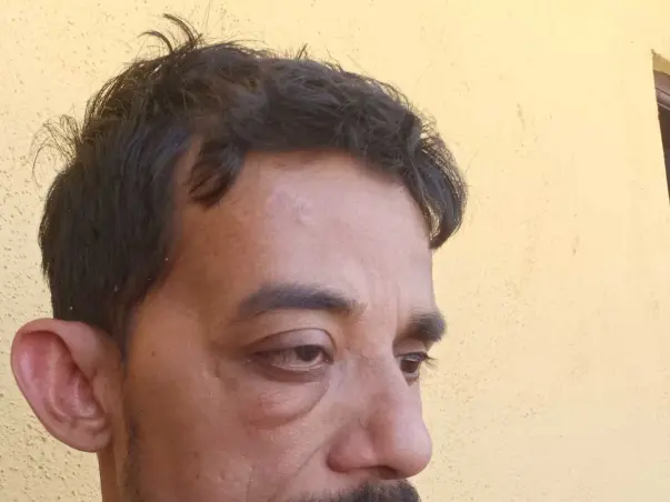 Help Nasurudeen To Recover From Eye Tumor