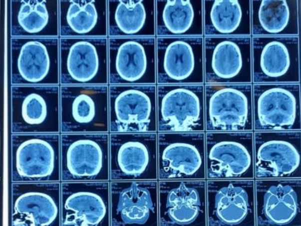 Support Anupa to recover from brain stroke