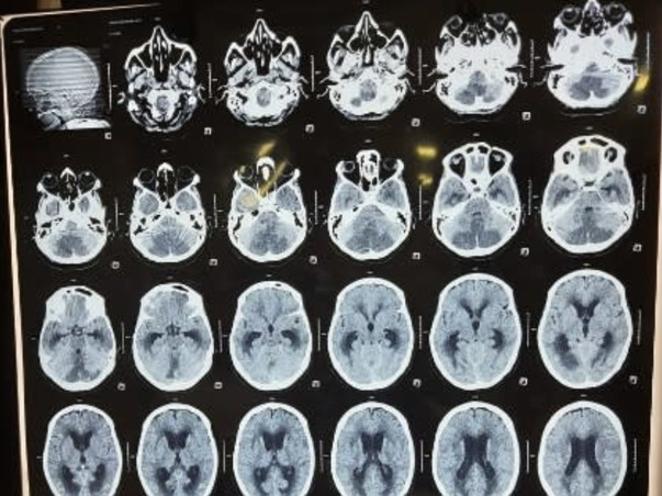 Support Anupa to recover from brain stroke