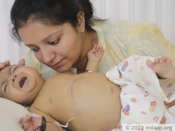 3-Month-Old With Swollen Belly Needs Urgent Liver Transplant