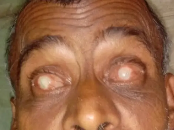 Support Anikul Islam To Undergo Ocular Surgery