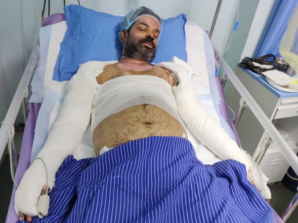 35 Years Old Prem Narayan Prajapati Needs Your Help Fight Severe Burns
