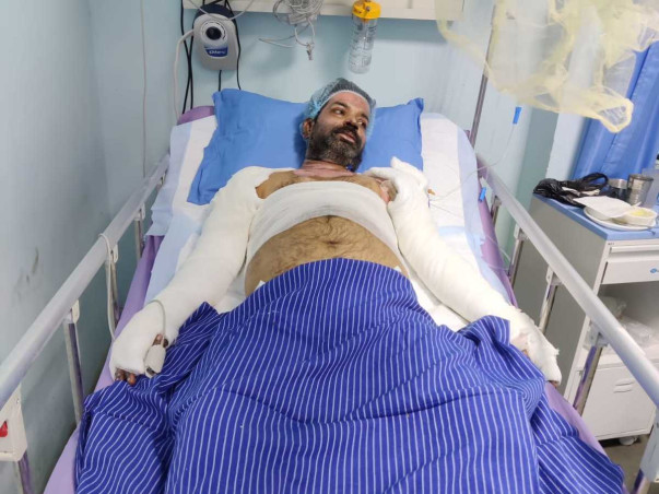 35 Years Old Prem Narayan Prajapati Needs Your Help Fight Severe Burns