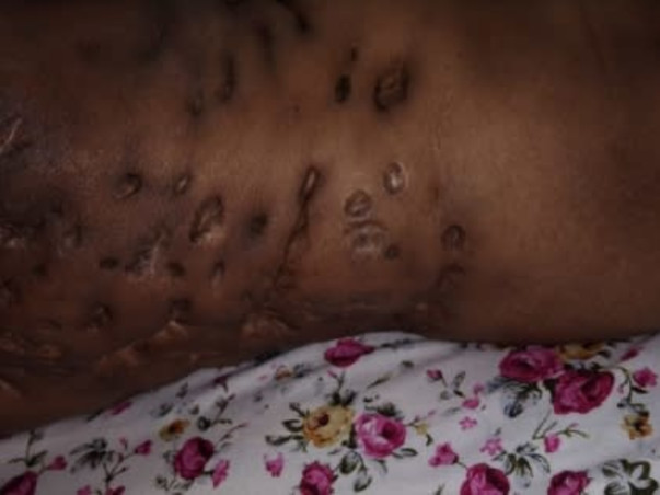 Help To Get Rid Of  Lymphedema And Cardiac Problem