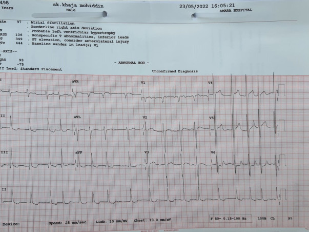 Support Sk.Khaja Mohiddin fight/recover from Degenerate Bioprothetic Valve with eccentric MR