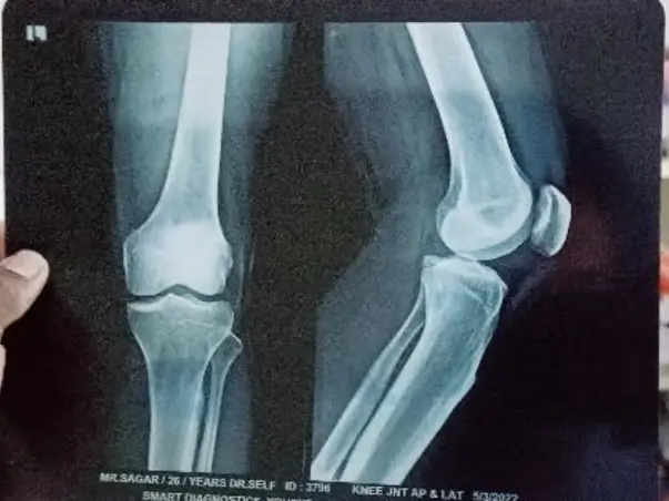 Help Sagar For his Knee Operation
