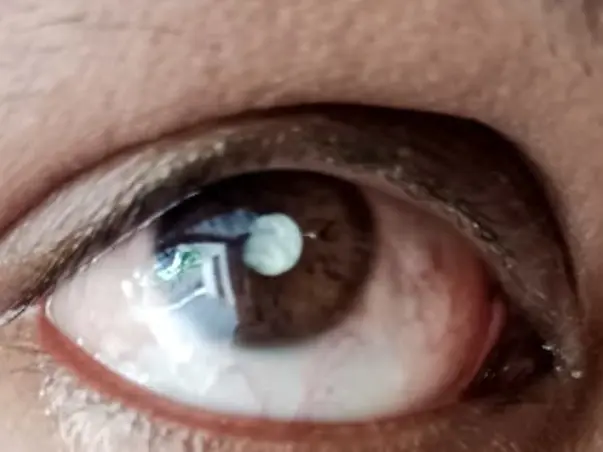 Vamhsi Krishna Eye problem