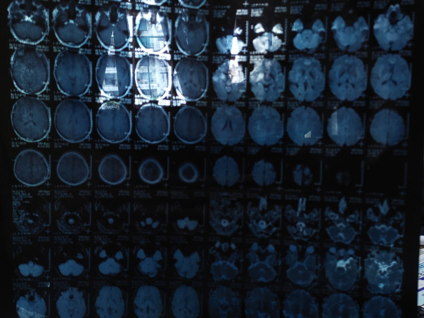 Help Me Fight Brain Tumor