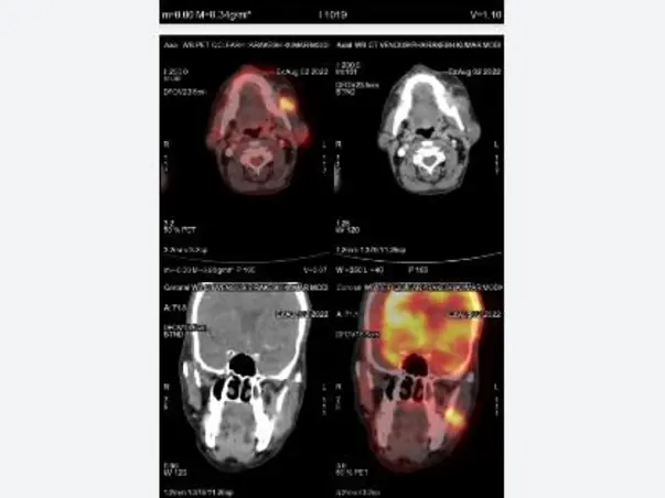 Help My Father Recover From Buccal Mucosa Cancer