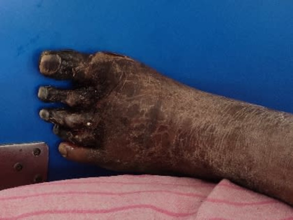 Help my father fight Peripheral artery disease