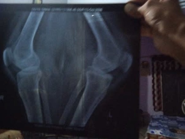 SAVE Divya Singh To Recover From Malignant Tumors