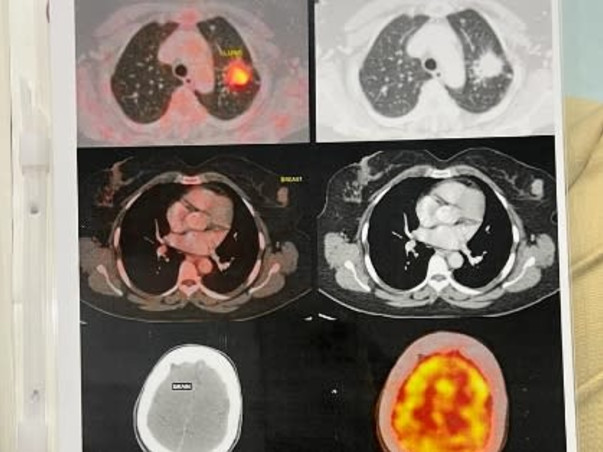 Please help my wife Kalyani fight Non small cell lung cancer