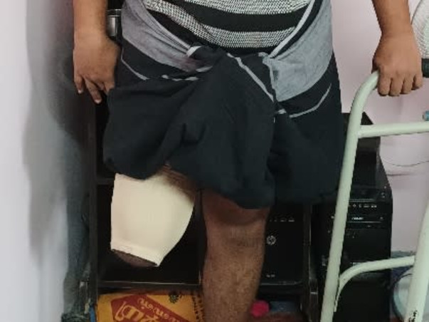Irsath 36/M  needs your help struggle for Prosthetic Leg