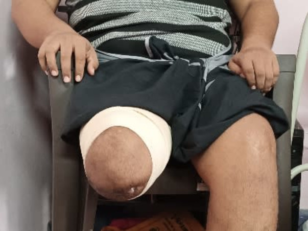 Irsath 36/M  needs your help struggle for Prosthetic Leg