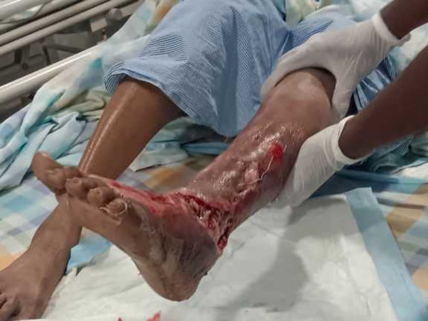 Support Bramarabha Recover From Cellulitis