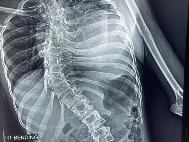 Support  Kampara Gnaneswari To Recover From Congenital Thoracic Kyphoscoliosis