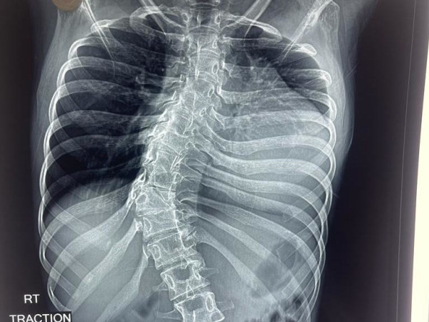 Support  Kampara Gnaneswari To Recover From Congenital Thoracic Kyphoscoliosis
