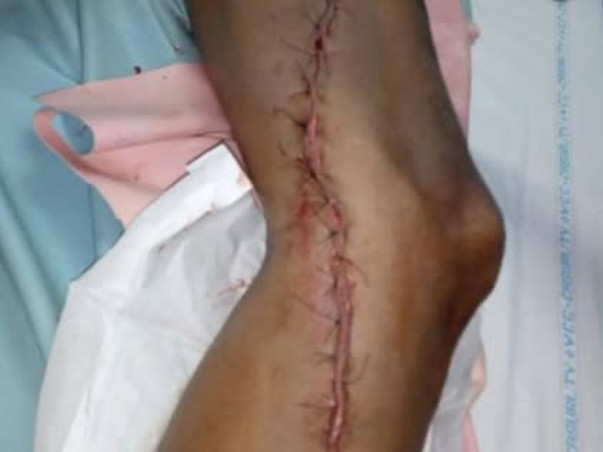 Support Devadi Kanaka Raju  To Recover From Peripheral Arterial Disease (Pad)