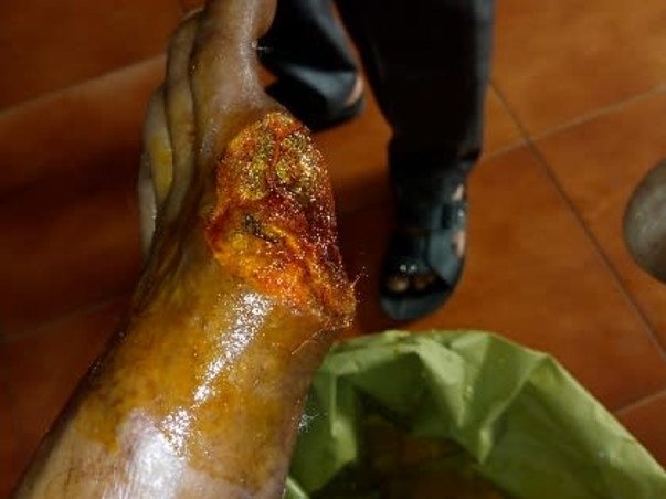 Support Devadi Kanaka Raju  To Recover From Peripheral Arterial Disease (Pad)