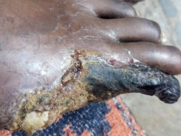 Support Devadi Kanaka Raju  To Recover From Peripheral Arterial Disease (Pad)