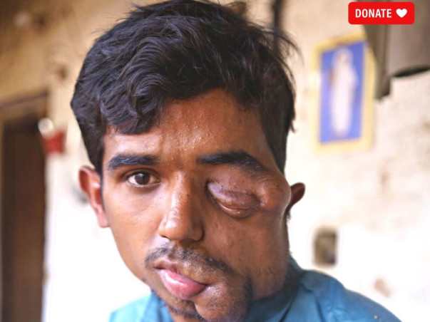Without Surgery, Complex Tumour Could Blind Him Permanently