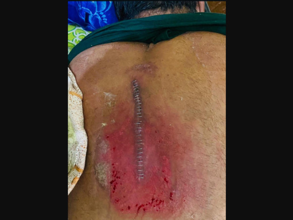 Help my father Pushkar Tiwari undergo spine surgery