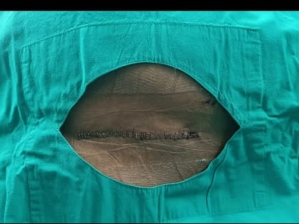 Help my father Pushkar Tiwari undergo spine surgery