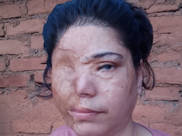 Help Faraha survive an acid attack