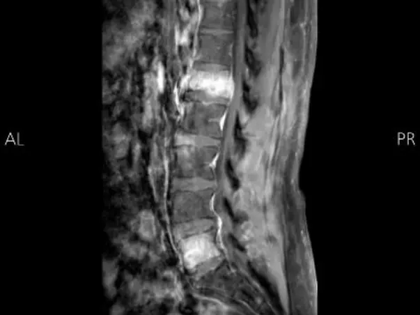 Support Birju Mody To Recover From Medullary Thyroid Cancer Metastatis
