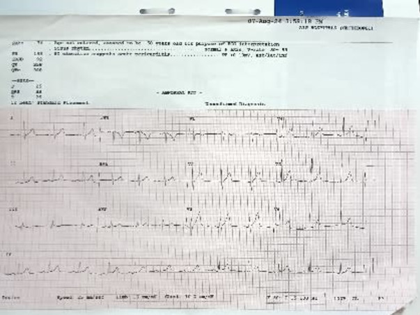 Myocardial bridging