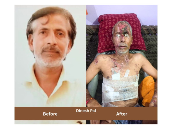 Support Dinesh's Surgery to Recover from a Devastating Acid Attack