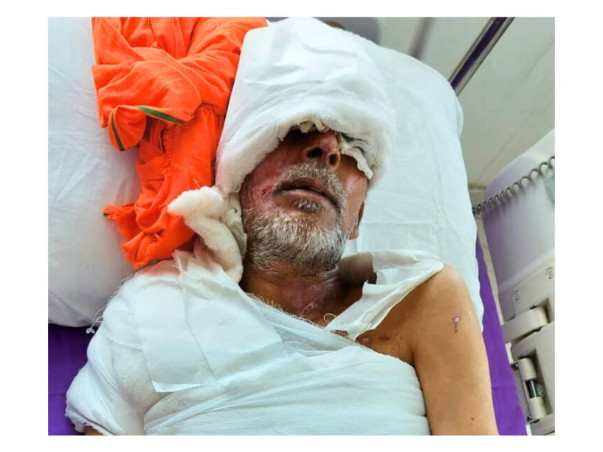 Support Dinesh's Surgery to Recover from a Devastating Acid Attack