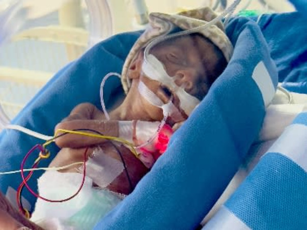 Support Baby Of Sowmya To Recover From Preterm Birth Complication