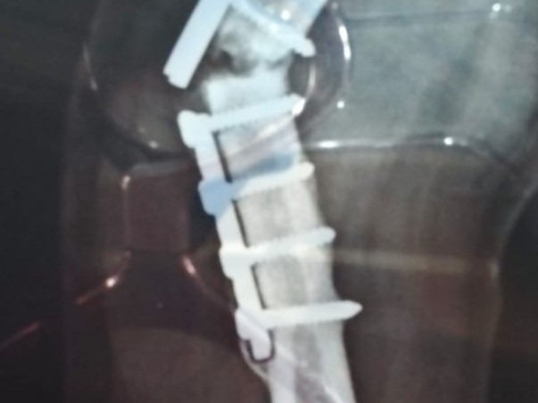 Support Srinivasu to Recover from accidental Spine hand andLeg Injury