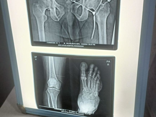 Support Srinivasu to Recover from accidental Spine hand andLeg Injury