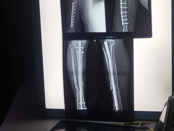 Support Srinivasu to Recover from accidental Spine hand andLeg Injury