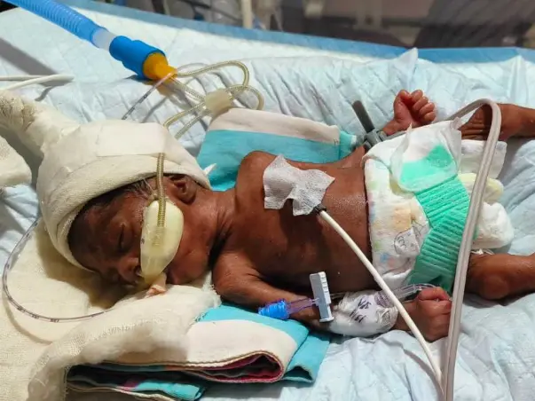 Tiny Fighter Help Baby of Shruti Maheshwari Born at twentyseventh week