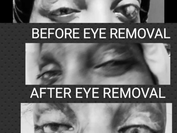 Support Pramodini Roul To Recover From Eye Disease