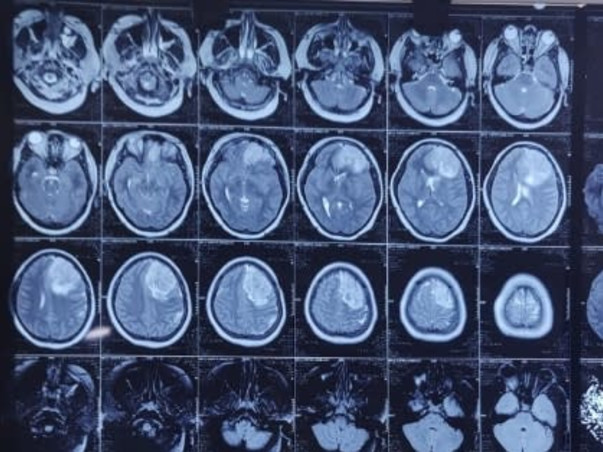 Support Shipra Shailesh To Recover From Brain Hemorrhage