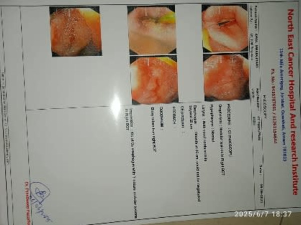 Support Amal Swarigiary To Recover From Esophageal Cancer