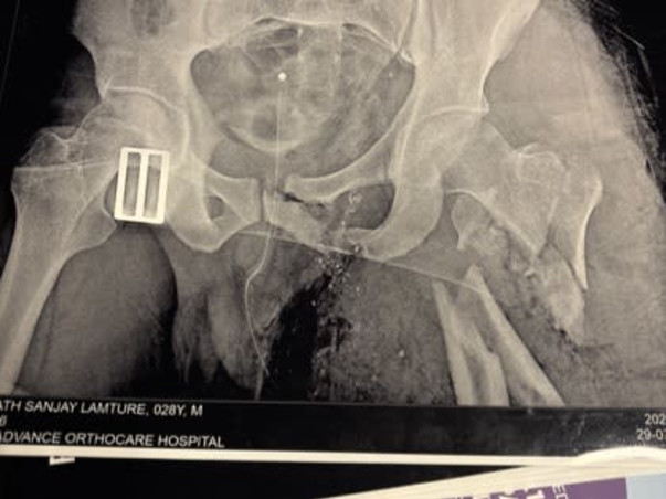 Help Vishvanath Recover After a Major Accident and Multiple Surgeries