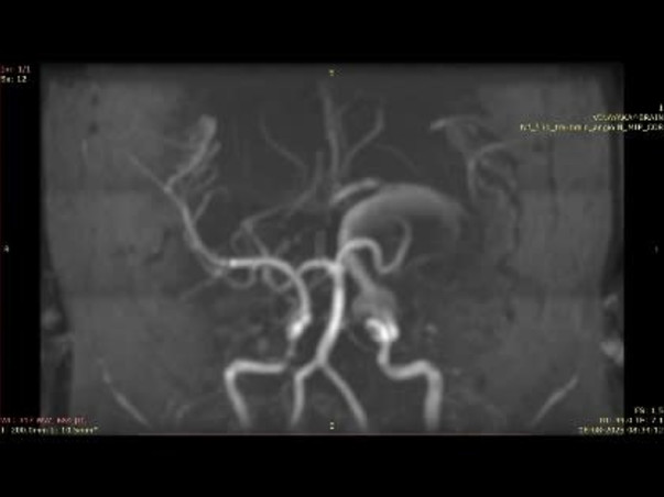 Support Vasavi R fight/recover from Endove Syndrome, Limb-Brain Type