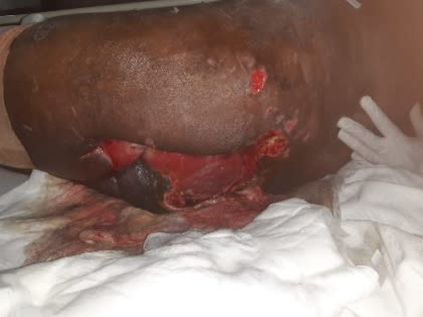 Support Tuhin (a budding scientist) to recover from a truck accident and able to walk again.