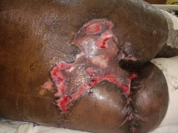 Support Tuhin (a budding scientist) to recover from a truck accident and able to walk again.