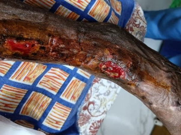 Support Tuhin (a budding scientist) to recover from a truck accident and able to walk again.