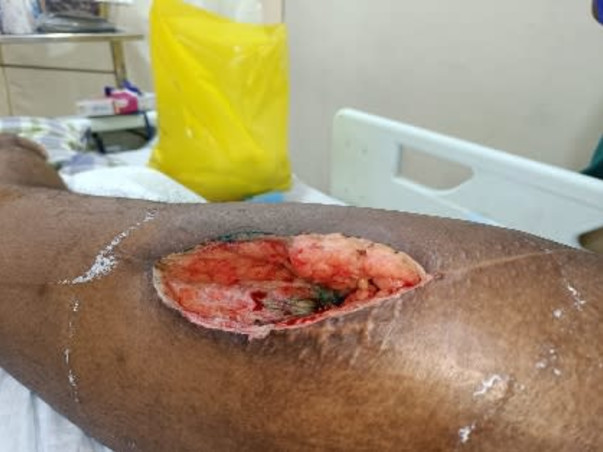 Support Tuhin (a budding scientist) to recover from a truck accident and able to walk again.