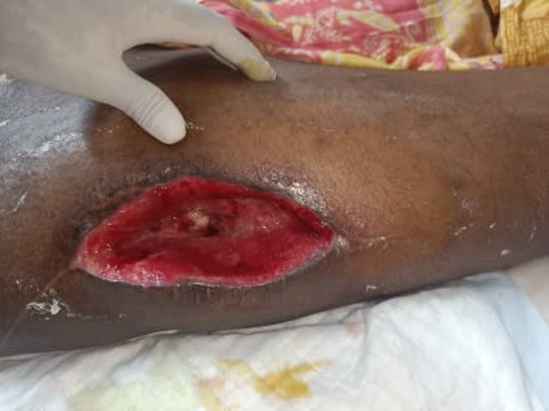 Support Tuhin (a budding scientist) to recover from a truck accident and able to walk again.