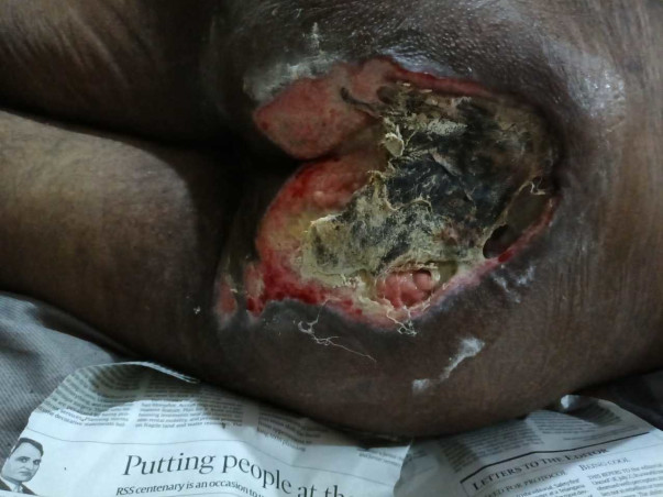 Support Adish Jain To Recover From Spinal Cord Injury