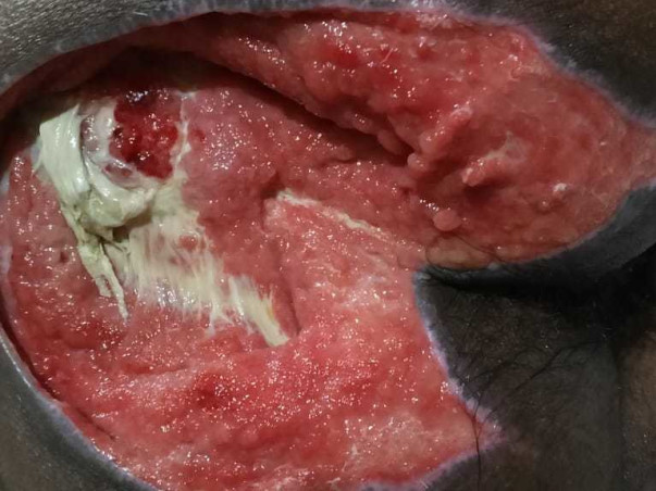 Support Adish Jain To Recover From Spinal Cord Injury