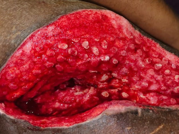 Support Tuhin (a budding scientist) to recover from a truck accident and able to walk again.